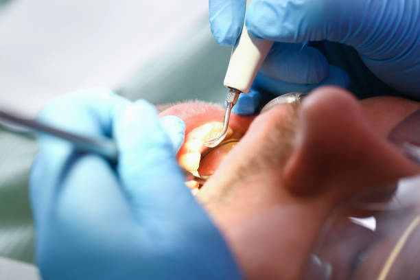 Best Knocked-Out Tooth Emergency  in Potomac Park, CA